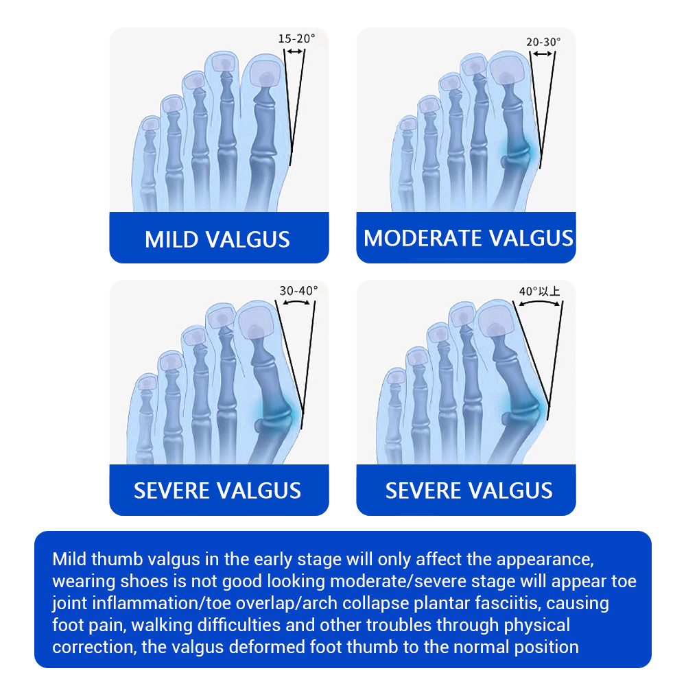 Halluks Valgus Düzeltici Ayarl - Toe Separator Silicon incelemesi ve fiyatı
